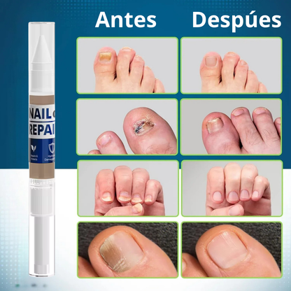 MyCurePro® Lápiz Antifúngico con Fórmula Avanzada – Contra Pie de Atleta y Hongos en Uñas